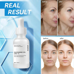 Niacinamide 10% + Zinc 1% Serum